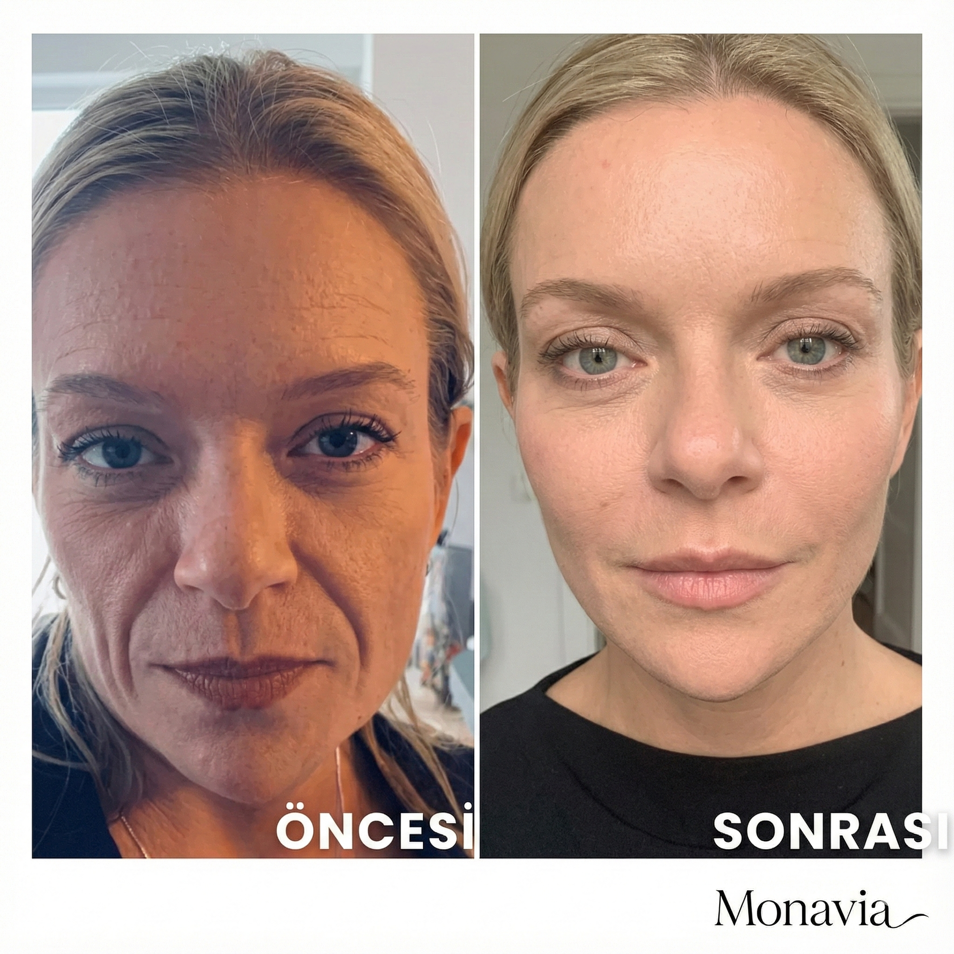 Görünmez Yüz ve Boyun Germe Bandı